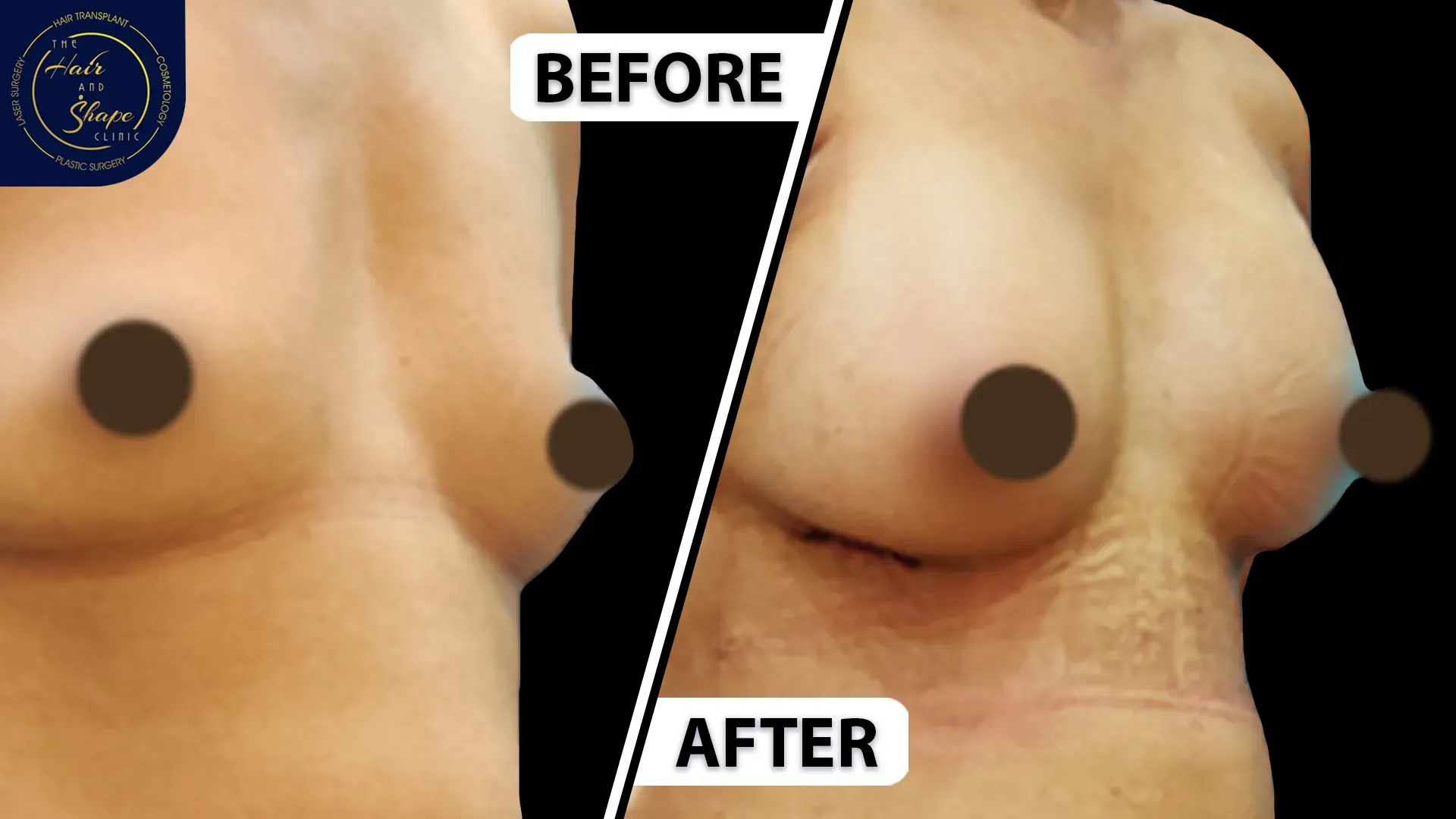 Breast Augmentation result7
